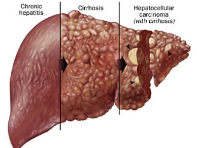 What can cause a blood clot in the liver?