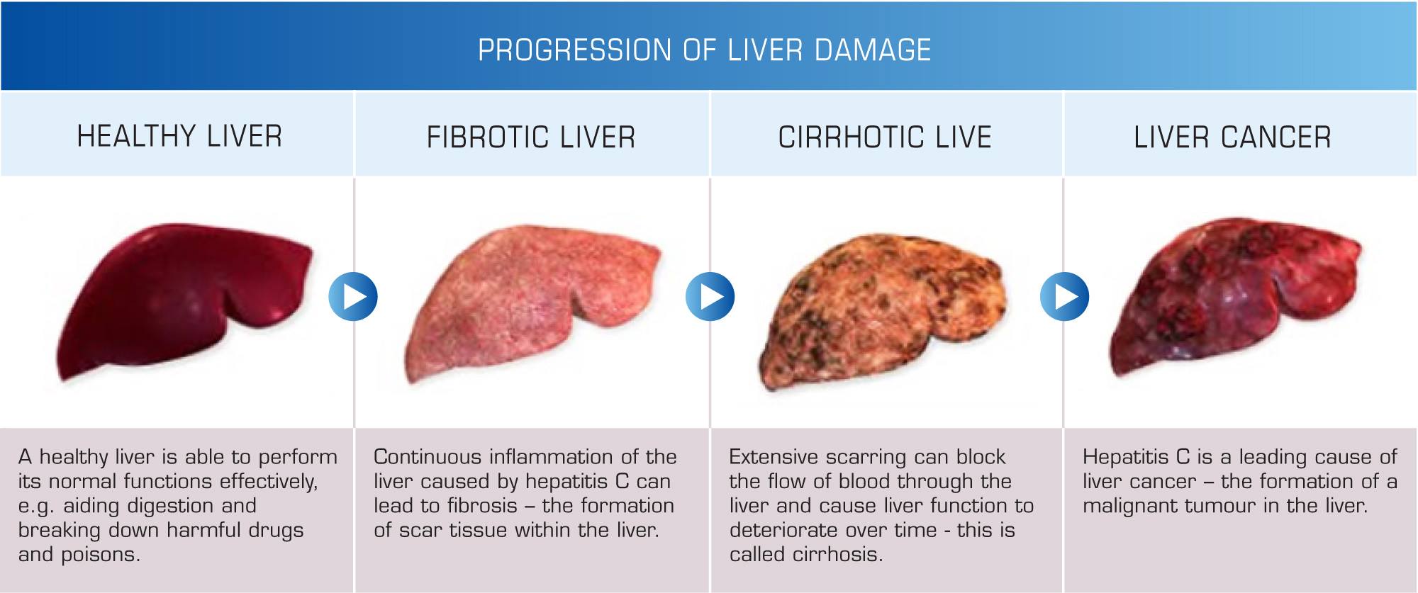 What can cause a blood clot in the liver?