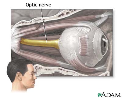 optic nerve atrophy treatment