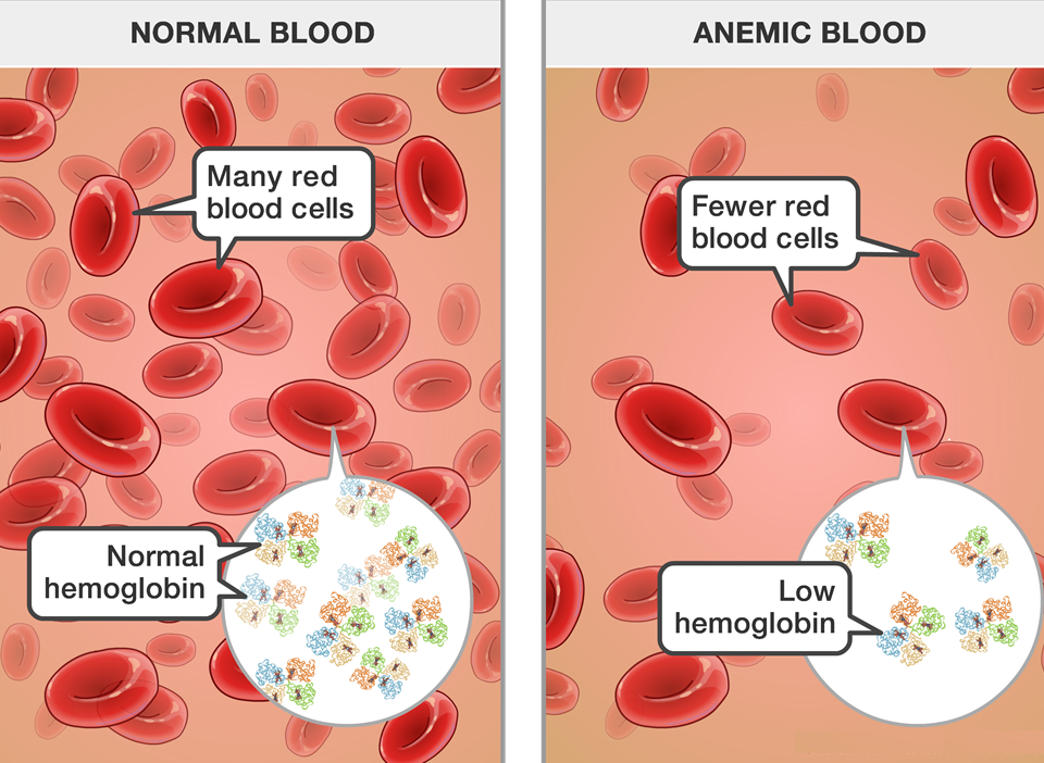 Anemia Treatment