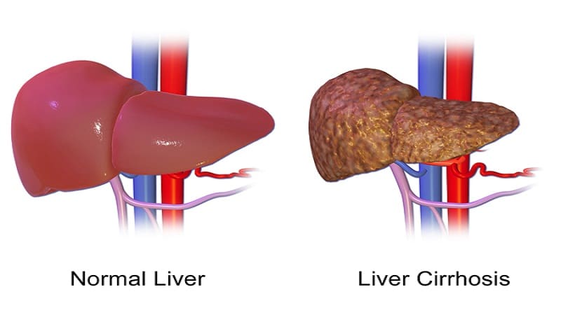 covid-19-stem-cells-for-liver-regeneration-and-its-restoration-after